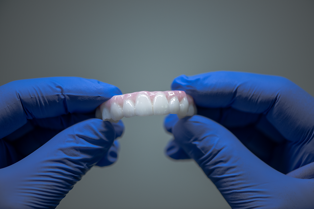 Implant Example